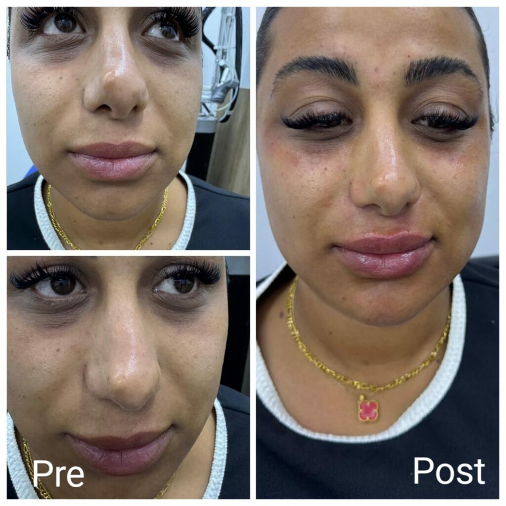 Filler for dark circles under the eyes and cheeks